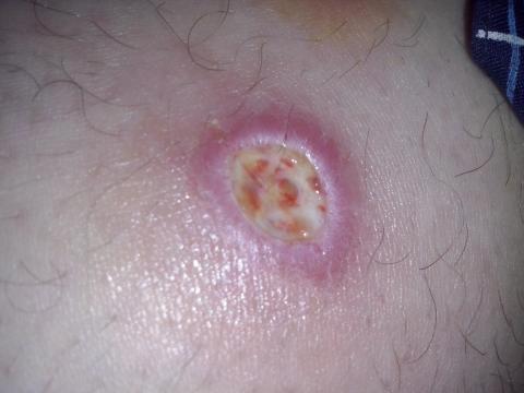 Následky uštipnutia